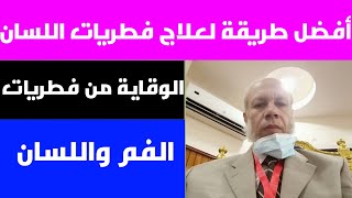 أسهل طريقة في علاج فطريات اللسان والفم علاج مونيليا الفم واللسان بسهولة #فطريات_اللسان