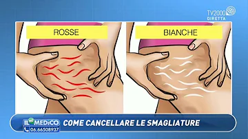 Per cosa vengono le smagliature?