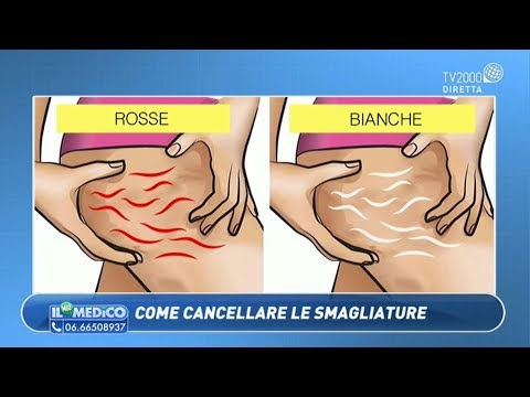 Video: Come Rimuovere Le Smagliature Sulle Gambe