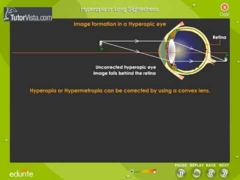 Hyperopia Or Long Sightedness Youtube