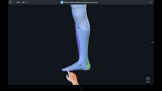 Understanding dermatomes of Lower Limb