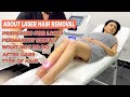 Everything you need to know about laser hair removal