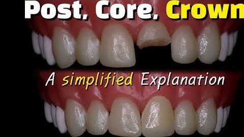 Fixing a broken front tooth with post,core build up and crown#viral