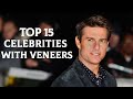 Top 15 Celebrities with Veneers : Secret to Celebrity Smile