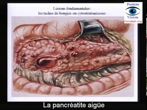 Vidéo: ❶ Comment Traiter La Pancréatite Aiguë