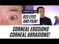 Red Eyes and Eye Pain From Corneal Abrasions?