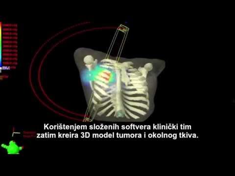 Video: MRI-zasnovana Zasnova Prilagojenih 3D Natisnjenih Aplikatorjev Ginekološke Brahiterapije Z Ukrivljenimi Kanali Igel