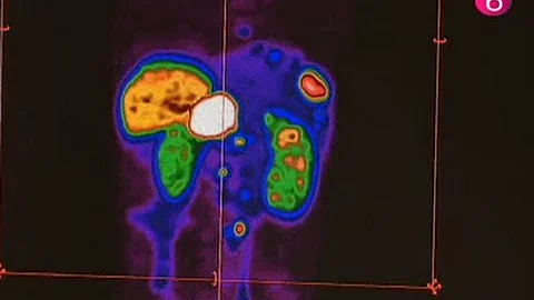Traitement tumeur neuro-endocrinale à Bordet