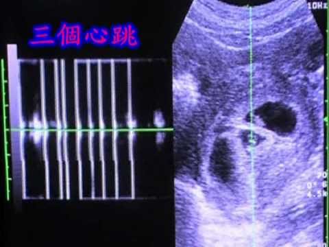 博元婦產科第三代試管嬰兒：(PGD)終結腓骨肌萎縮症(CMT)三代遺傳
