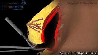 Breast Implant Revision Surgery Animation By Dr. Steve Merten