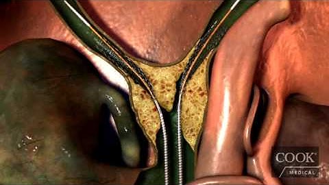 Zilver 635® Biliary Self-Expanding Stent Animation