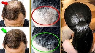 СУПЕР-УВЕЛИЧЕНИЕ РОСТА ВОЛОС НА ЗАЛЫСИНАХ !! САМЫЕ ЭФФЕКТИВНЫЕ РЕЦЕПТЫ ОТ ОБЛЫСЕНИЯ... СУПЕР-УВЕЛИЧЕНИЕ РОСТА ВОЛОС НА ЗАЛЫСИНАХ !! САМЫЕ ЭФФЕКТИВНЫЕ РЕЦЕПТЫ ОТ ОБЛЫСЕНИЯ...