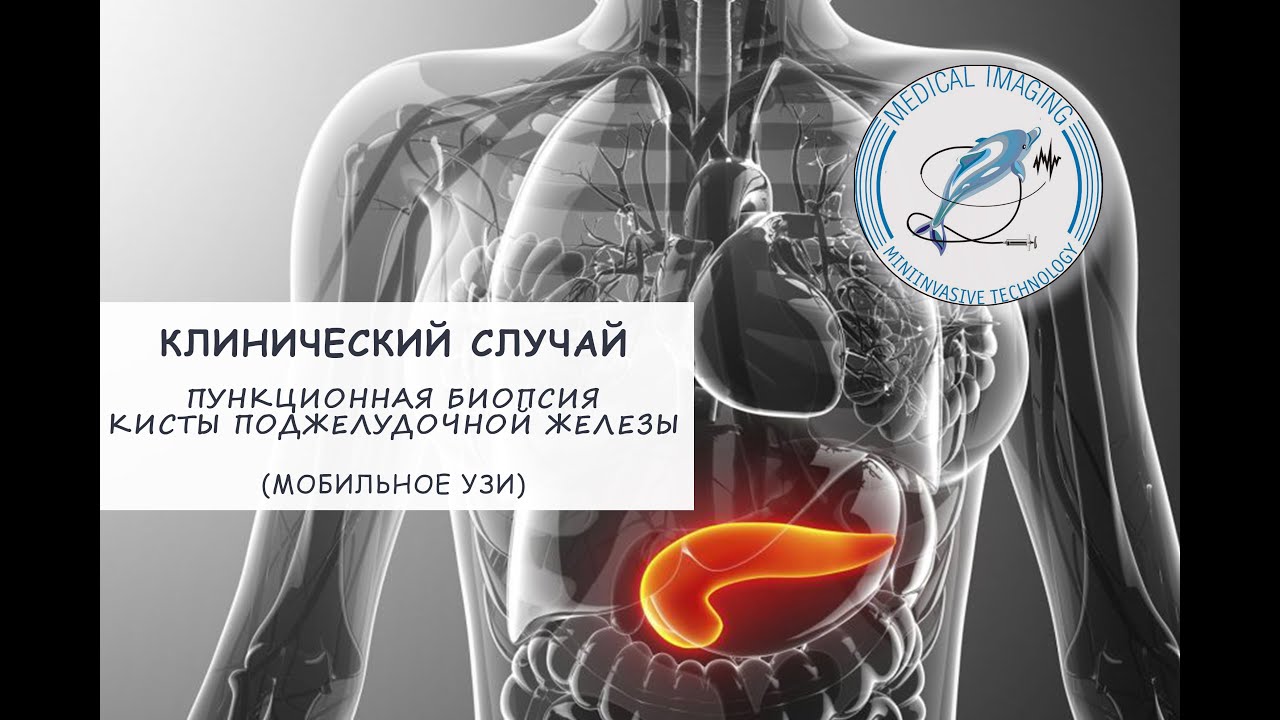 Пункционная биопсия кисты хвоста поджелудочной железы (мобильное УЗИ ...