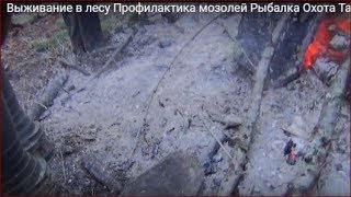 видео Архивы Мозоли