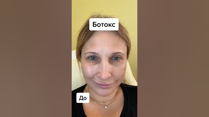 Ботокс. Результат до/после.