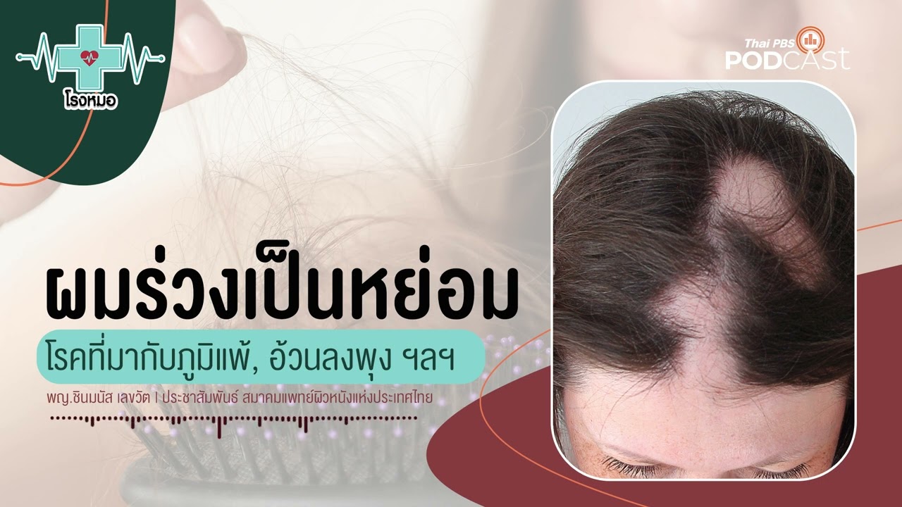 โรคผมร่วงเป็นหย่อม | โรงหมอ - YouTube โรคผมร่วงเป็นหย่อม | โรงหมอ - Youtube