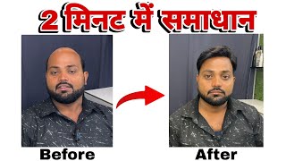 गंजेपन का समाधान सिर्फ 2 मिनट में#hairpatchfixing#hairwighouse #hairstyles #hairreplacement