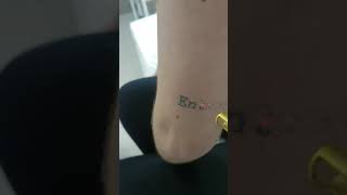 Remoção de Tatuagem