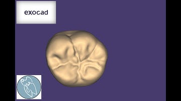 ExoCad 3D Design Mandibular First Molar