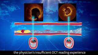 Innovative Functions-Index of Plaque Attenuation (IPA) of Vivolight Medical