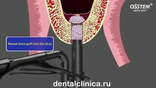 Стоматология лечение зубов имплантация в Москве Санкт-Петербурге протезирование европейское качество(, 2014-03-25T19:36:28.000Z)
