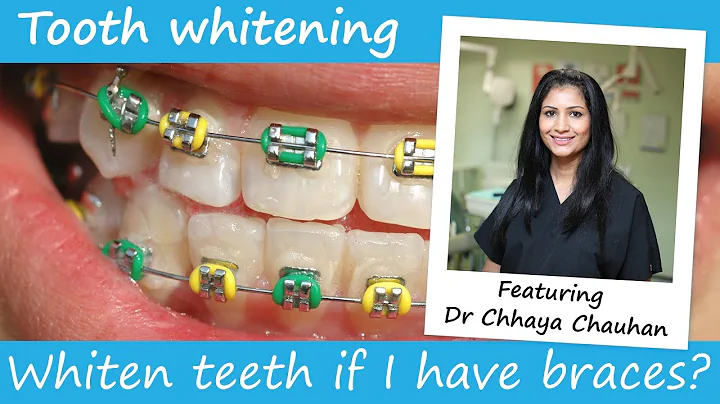 Can you have teeth whitening with braces on?
