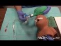 NICU Procedures- Surfactant administration in a preterm infant