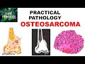 OSTEOSARCOMA: Clinical , Radiological features & Morphology