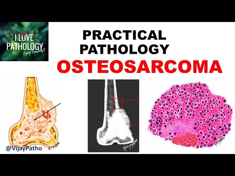 Wideo: Jaka jest etiologia kostniakomięsaka?