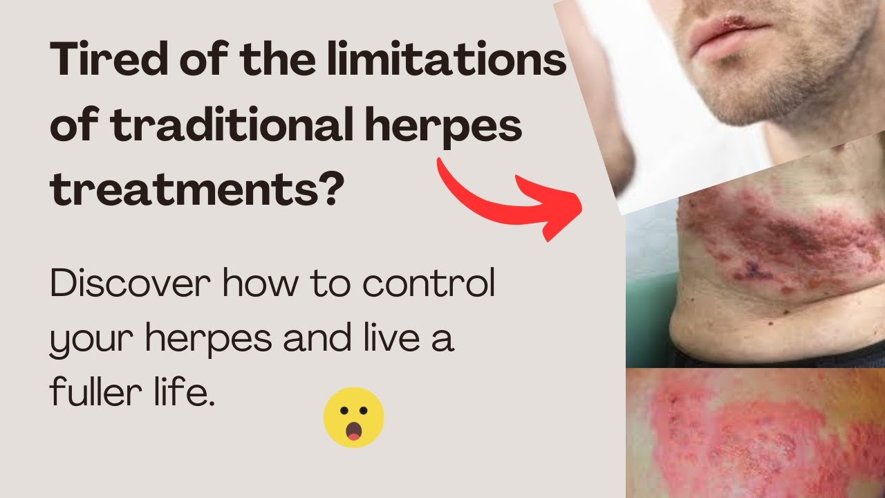 Natural supplements Herpes Relief Solution