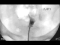 Hysterosalpingogram / HSG