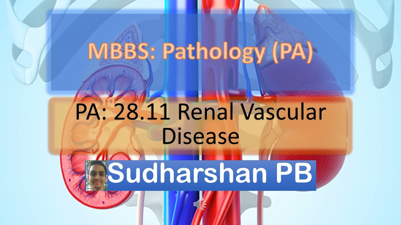 MBBS PA 28.11 Renal Vascular Disease | Sudharshan PB