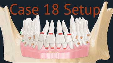 Maestro 3D aligners virtual setup: case 18, anterior crowding, the newest protocols