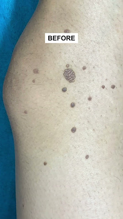 Skinaa Flat Warts: Causes, Treatment & Prevention!