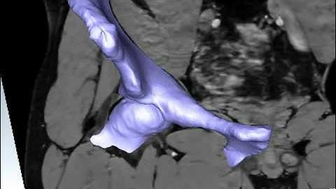 Hip bone MRI segmentation using statistical shape model