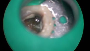 18571 tough broken file removal with indirect ultrasonics