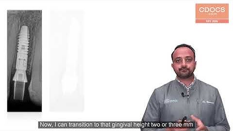 Tip of the Day: TruAbutment