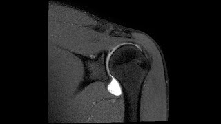 MRI Shoulder Part 3:  Rotator Cuff disease