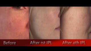 IPL Photofacial Review After 4 Treatments ~ Before & After