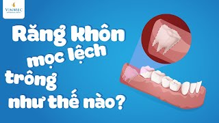 Răng khôn mọc lệch trông như thế nào?| BS Phạm Thị Hiền, BV Vinmec Hải Phòng
