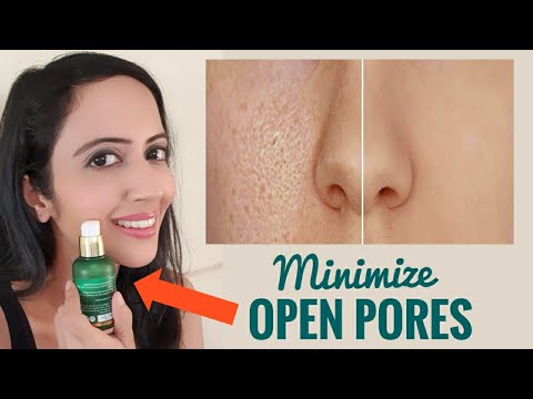 How I am treating my OPEN PORES | Enlarged Pores - Causes & Treatment