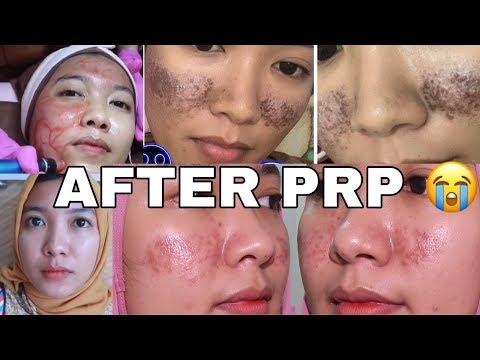 Video: Microneedling Dengan PRP: Manfaat, Efek Samping, Pemulihan & Lainnya