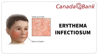 Erythema Infectiosum by CanadaQBank 572 views 9 days ago 8 minutes