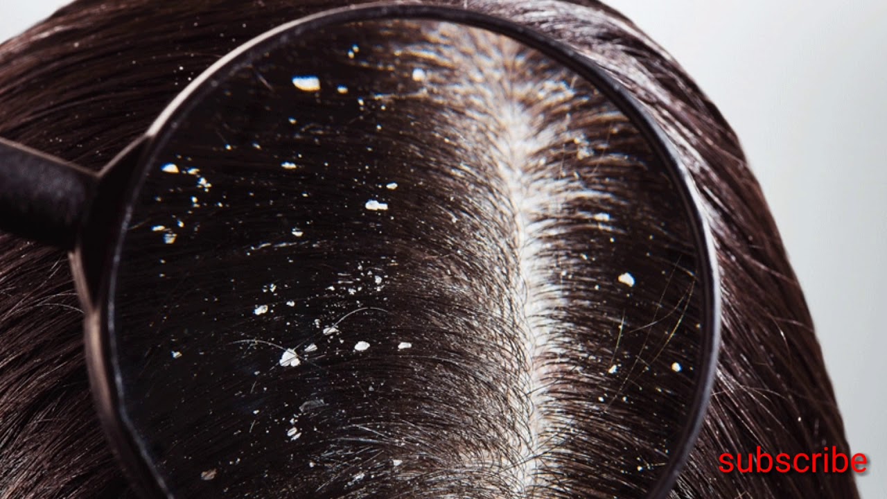 How To Remove Dandruff At Home Tips താരൻ അകറ്റാൻ YouTube