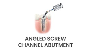 Guide To Implant Restoration: Angled Screw Channel Abutment