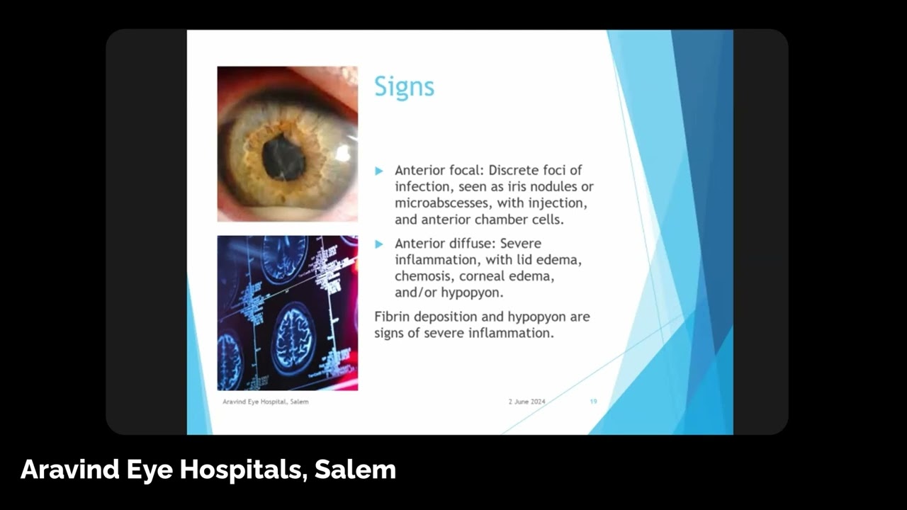 Endogenous Endophthalmitis- Dr. Manohar Babu Balasundaram, CMO, Aravind Eye Hospital, Salem