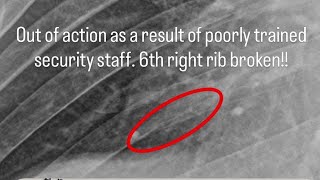 I Was Recently Illegal Assaulted ￼By Security And Now Have A Broken Rib - Read Description For More