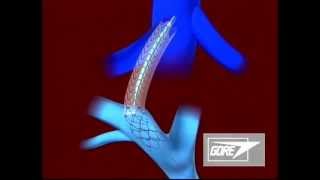 Endoprosthesis - Transjugular Intrahepatic Portosystemic Shunt (TIPS)