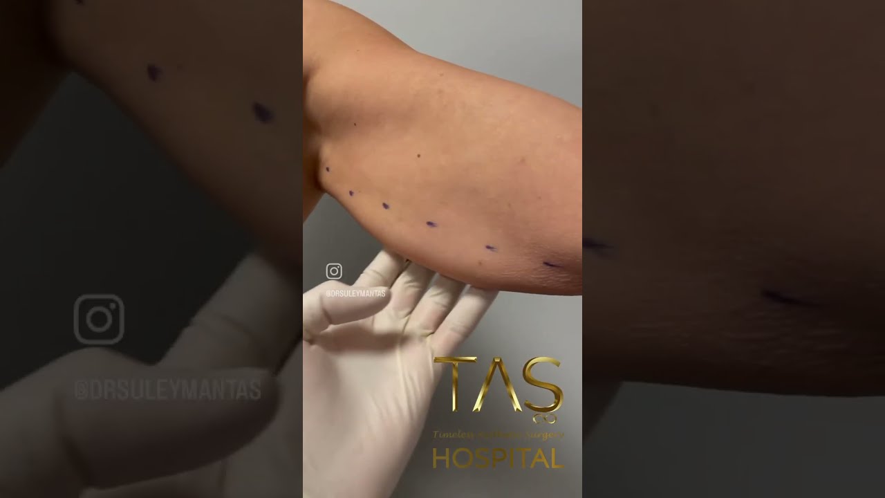Revolutionary Scarless Arm Lift Achieve Toned Arms With Dr TAS