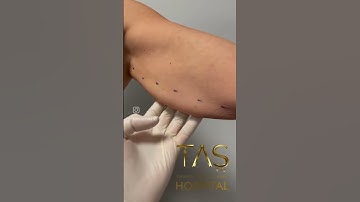 Revolutionary Scarless Arm Lift: Achieve Toned Arms with Dr. TAS